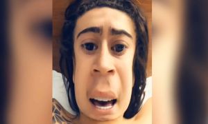 harmonização facial