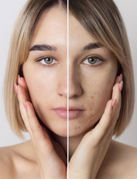 Melasma: Desvendando as Abordagens Eficazes para o Farmacêutico Esteta