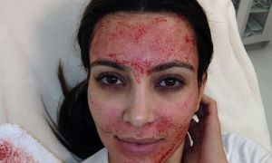 kin-facelift-vampiro