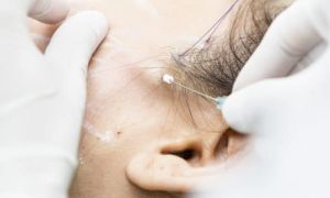 lifting com Fios PDO