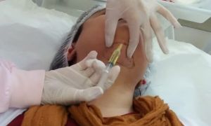 6 dúvidas frequentes sobre Lipo de Papada