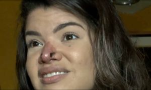 Priscilla Aguiar - Rinomodelação