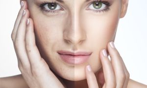 peeling mecânico e químico