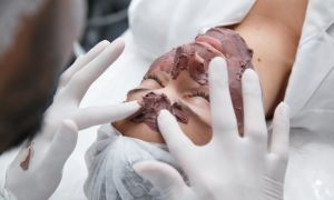 Peeling: outono e inverno são as estações com maior procura de procedimentos com ácido