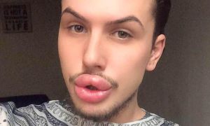 preenchimento labial