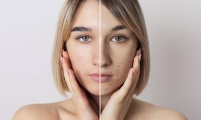 Melasma: Desvendando as Abordagens Eficazes para o Farmacêutico Esteta
